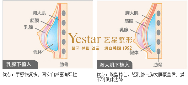 隆胸假体放置位置