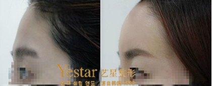 玻尿酸